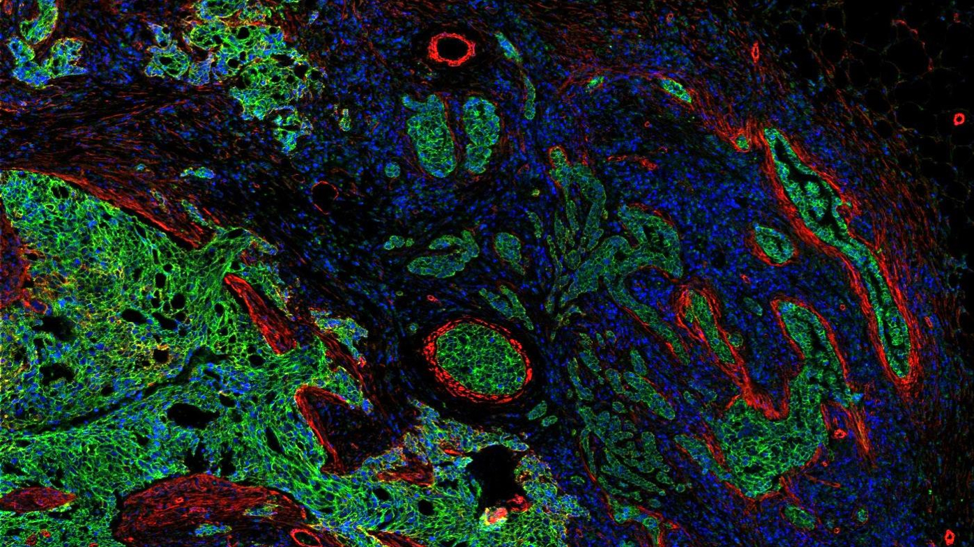 35 Biomarker ergeben eine zelluläre Landschaft des Tumors und des umliegenden Gewebes.