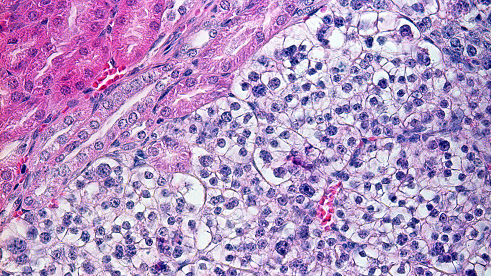 Das Bild zeigt Maus-Tumoren mit klarzelligen Nierenzellen neben gesunden Nierentubuli.