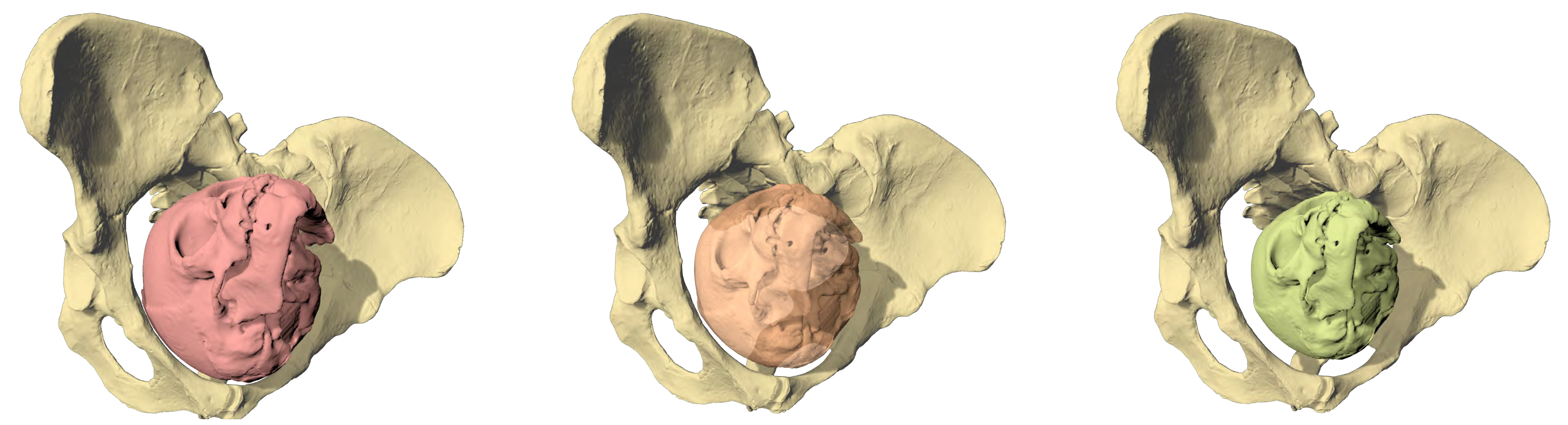 Birth simulation of Lucy (Australopithecus afarensis) with three different fetal head sizes. Only a brain size of maximum 30 percent of the adult size (right) fits through the birth canal. (Picture: Martin Häusler, UZH)