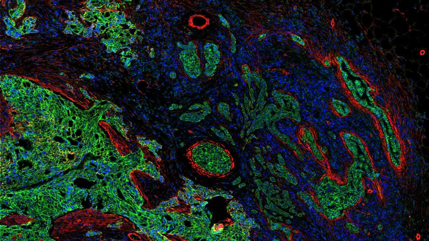 35 protein biomarkers create an unprecedented view of a tumor’s cellular landscape and the surrounding tissue. (Image: Bernd Bodenmiller / UZH)