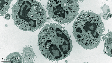 Das Bild zeigt eine elektronenmikroskopische Aufnahme von Fresszellen. Bei der Immundefektkrankheit Septische Granulomatose sind die Fresszellen wegen eines Genfehlers nicht mehr fähig, Bakterien und Pilze abzutöten.
