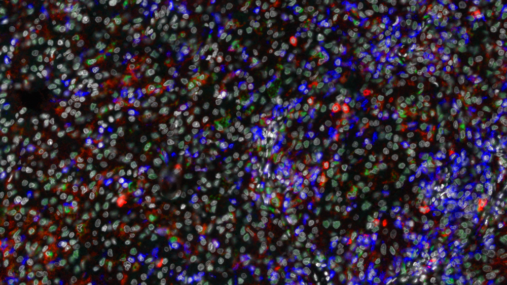 Die Fluoreszenzaufnahme zeigt verschiedene Typen von Makrophagen (grün) und T-Zellen (blau), die sich in der Mikroumgebung eines Nierentumors befinden.
