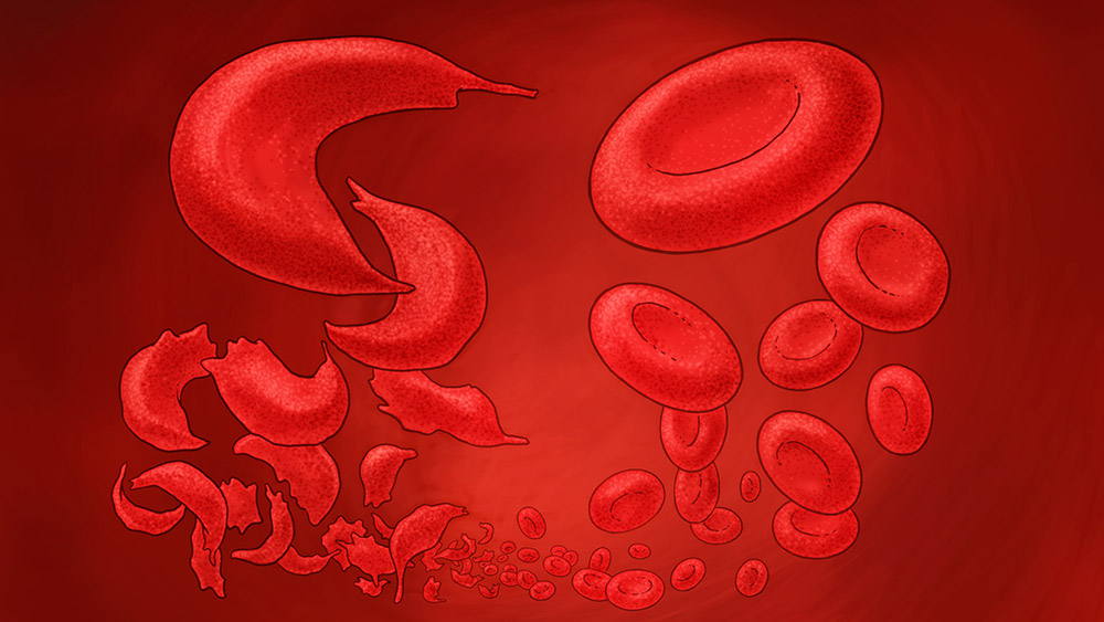 Bei Sichelzellanämie-Patienten kristallisiert der rote Blutfarbstoff Hämoglobin, wodurch die normalerweise runden Blutkörperchen (rechts) sich zu Sicheln (links) verformen.