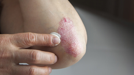 Das Bild zeigt den Ellbogen einer Person mit Schuppenflechte, einer entzündlichen Hautkrankheit.