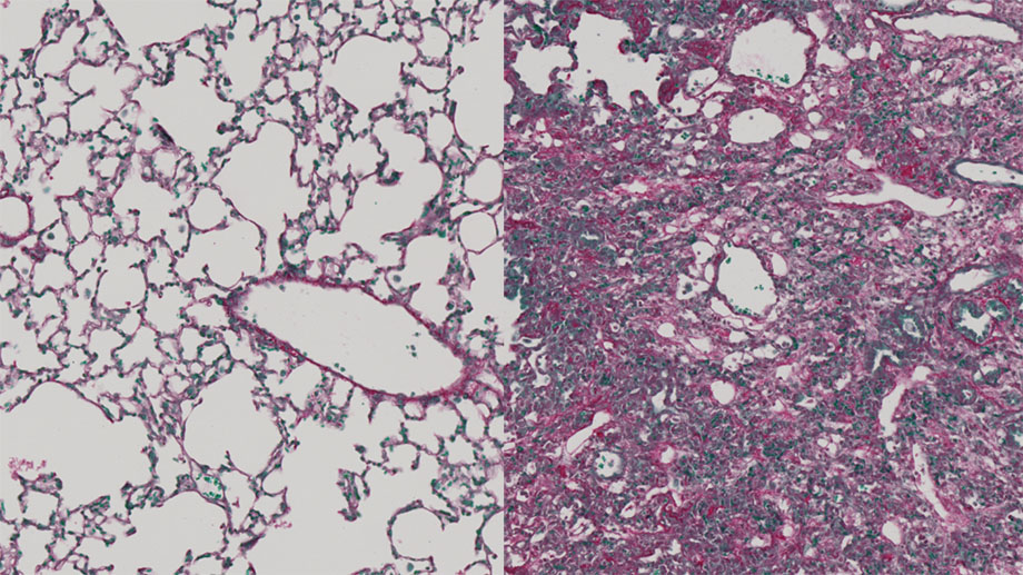 Healthy (left) and fibrotic lung tissue (right)