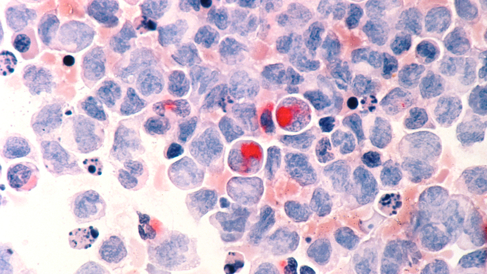 Menschliche Blutzellen, rot angefärbt sind Krebszellen der akuten myeloischen Leukämie erkennbar. (Bild: NIH) 