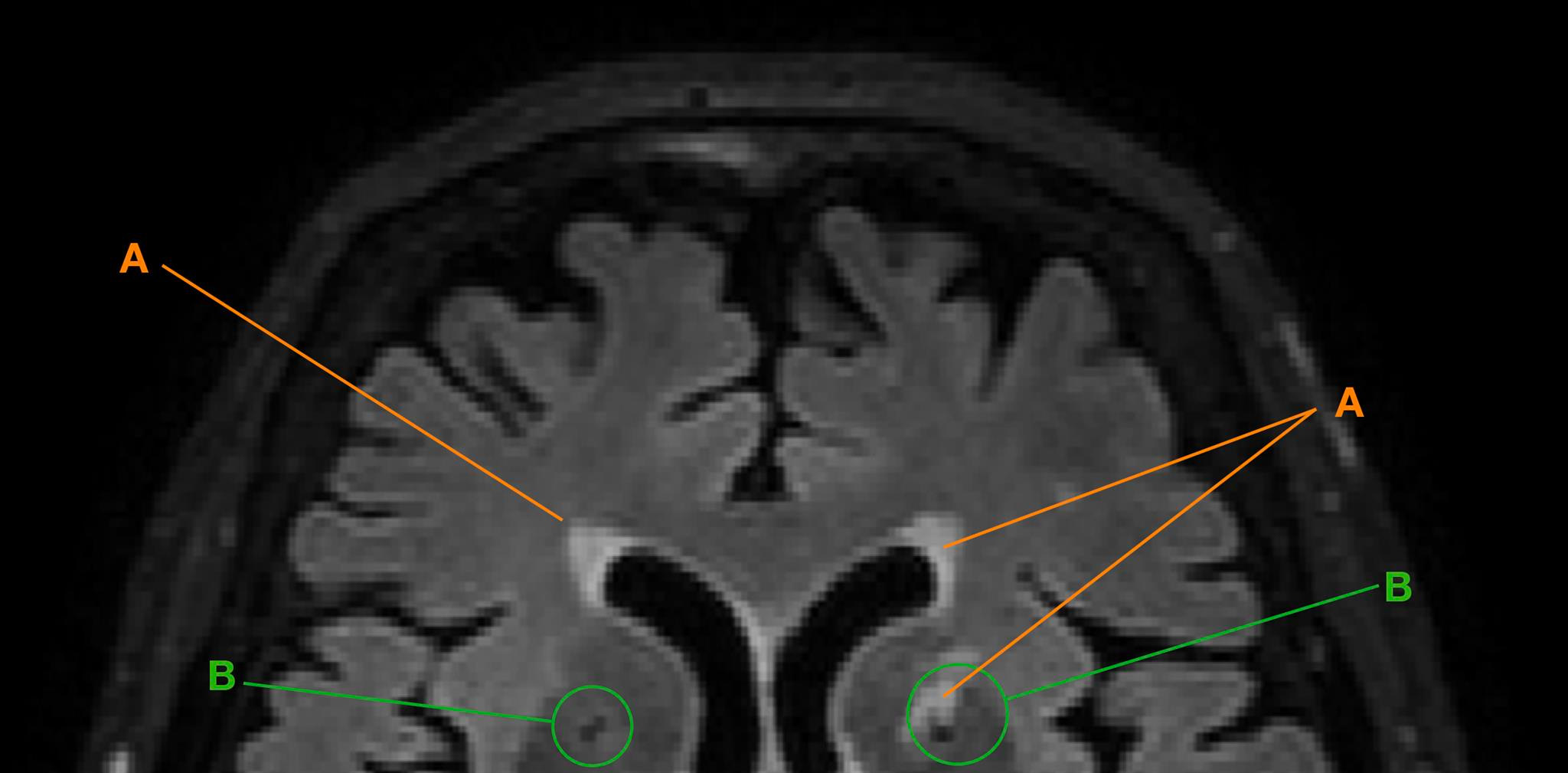 Ausschnitt eines mittels MRT gemessenen Gehirns im Horizontalschnitt mit Hyperintensitäten der weissen Substanz (A) und Lakunen (B).  